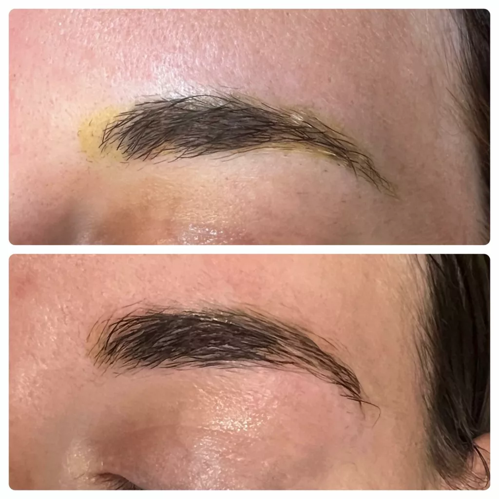 Semi-Permanent makeup removal after one session